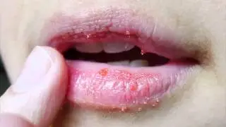 Tips How to Cure Dry And Chapped Lips Fast