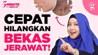 Cara Hilangkan Bekas Jerawat Dengan Berkesan