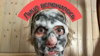 ЛИЦО ВСПЕНИЛОСЬ! | ну и рожа- ну и кожа!