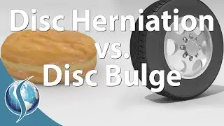 Herniation vs Bulge