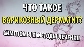 Что такое варикозный дерматит - симптомы и методы лечения