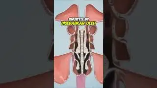 What is sinusitis What causes it 