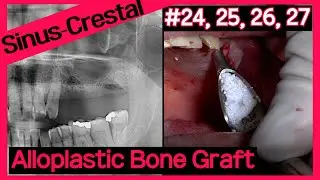 [Online Surgery] Implant placement with Mx. Sinus crestal approach using OneCAS system