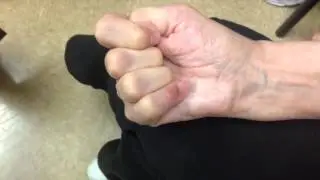 What Does A Finger Fusion Look Like?