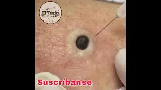 Extracción de granos gigantes⚠️😱