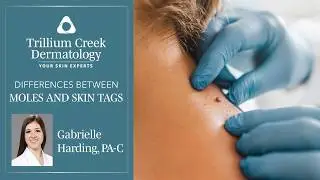 Moles and skin tags