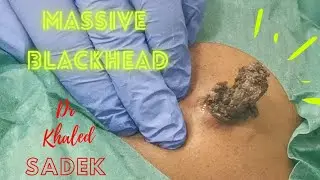 Live Chat episode 252. with . Dr Khaled Sadek.