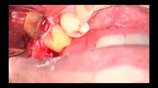 Biological Shaping #19 Waterlase Iplus   SD 480p