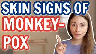 MONKEYPOX OUTBREAK 2022 SKIN SIGNS *UPDATE* DERMATOLOGIST 