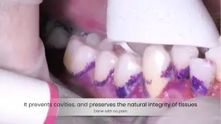 Professional Dental Cleaning