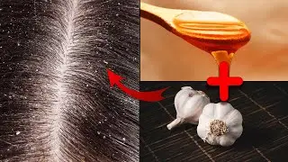 Why no one had mentioned this easy solution to treat dandruff? [Dandruff Treatment]