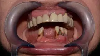 All-on-4® операция. 4 случаи. Papadent клиника.
