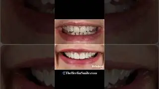The power of veneers!🙏🏼 #shorts #veneers #crowns #dallassmiles #tiktok #fyp