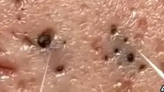 Kind of Blackheads, Pimples and Acne