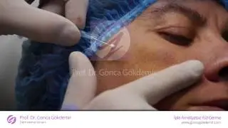 İple ameliyatsız yüz germe - Prof. Dr. Gonca Gökdemir
