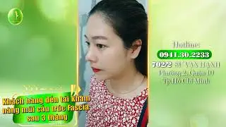 Khách hàng đến tái khám nâng mũi cấu trúc Fascia sau 3 tháng