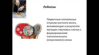 Гемобластозы в практике терапевта