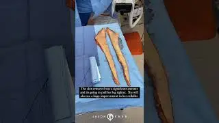 LIPEDEMA LED LIPO + THIGH LIFT | Dr. Jason Emer