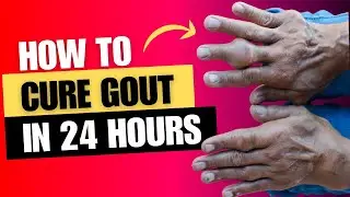 24-Hour Gout Relief: Natural Remedies Unveiled!