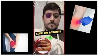 SOFRI UM ACIDENTE