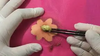 Treatment Of Blackhead Removal at Lam Dep Spa #040
