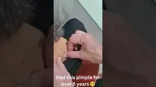 Had this pimple for over 5 years 😵‍💫