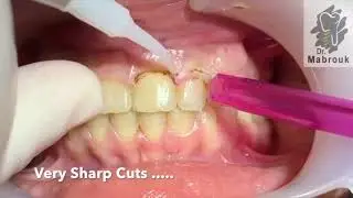 Clinical Crown Lengthening