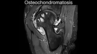 Synovial Osteochondromatosis