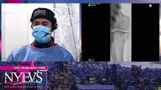 LIVE CASE PRESENTATION #5   ISR FEMOROPOPLITEAL DISEASE   Broadcast From  The Mount Sinai Hospital,