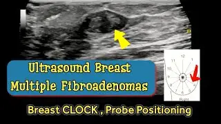Breast Multiple Fibroadenomas - Positioning according to Breast Clock | Ultrasound