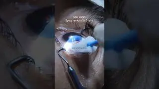 LASIK Laser eye surgery 