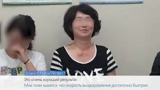 Спастическая кривошея / Пример лечения Дистония