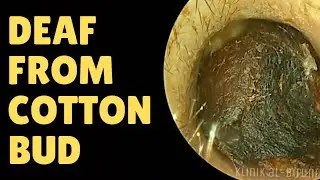 Deaf From Cotton Bud