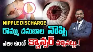 రొమ్ము నుండి రక్తం రావడం ప్రమాదకరమా ? | Signs of breast cancer telugu | Dr.Deepak Koppaka | Kaizen