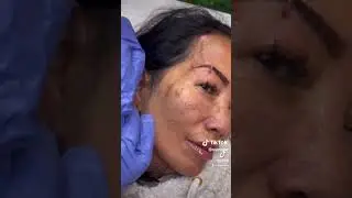 YOU WONT BELIEVE HER RESULTS! PDO THREADLIFT ANYONE?