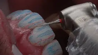 Facetas diretas de resina - acabamento - áreas de brilho e sombra