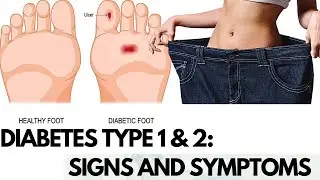 DIABETES TYPE 1 AND 2: Signs And Symptoms, Causes, Prevention And Treatment