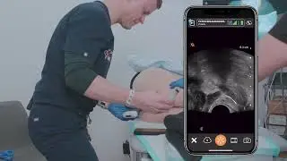 Transrectal Periprostatic Block