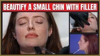 Enhance a Small Chin With Filler | Chin Filler Tutorial