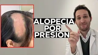Alopecia por presión: los peligros de los procedimientos estéticos