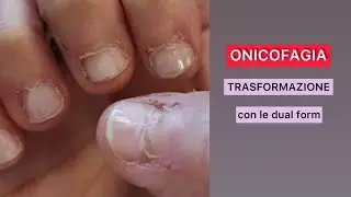❗️UNGHIE ONICOFAGIGHE❗️Trasformazione con le dualform #unghie #ricostruzioneunghie