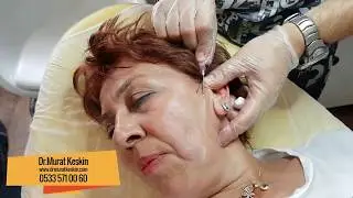 Ameliyatsız Yüz Germe İşlemi