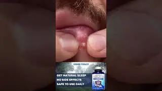 Best Pimples - Amateur New Pops for 2023