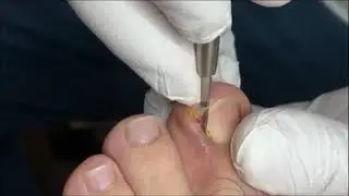 ingrown toenail pt 1 | cantengan |