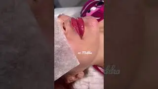 #контурнаяпластикагуб