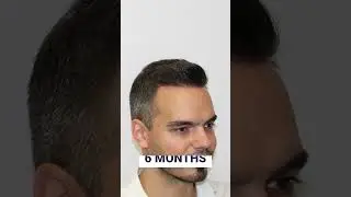 1500 GRAFTS TRANSFORMATION #hairpalace  #hairtransplantresults #hairtransplantbeforeafter #shorts