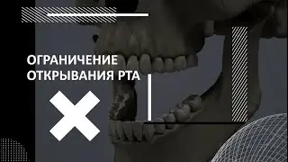 ОГРАНИЧЕНИЕ ДИНАМИКИ ЧЕЛЮСТИ
