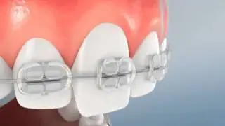 Incisor Eruption for Perio