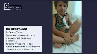 Травма лучевого нерва. Перелом плечевой кости. результат.