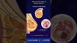What are the types of Breast Cancer? #breastcancer #genomics #bioinformatics #cancer #research